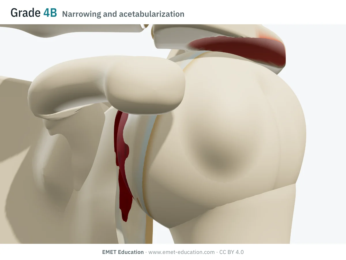 Shoulder in 3D, front view, Hamada grade 4B: narrowed glenohumeral joint space and hollowed acromion, the head in contact with both.