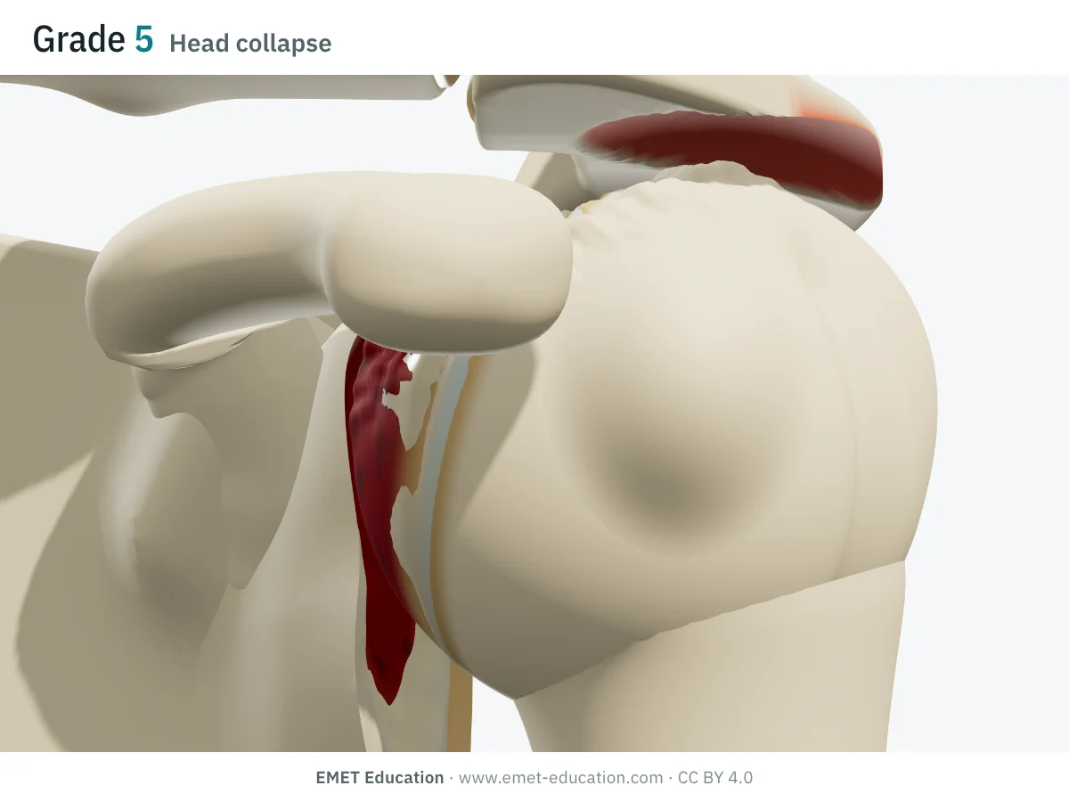 Shoulder in 3D, front view, Hamada grade 5: top of the humeral head flattened and irregular, against a hollowed acromion.