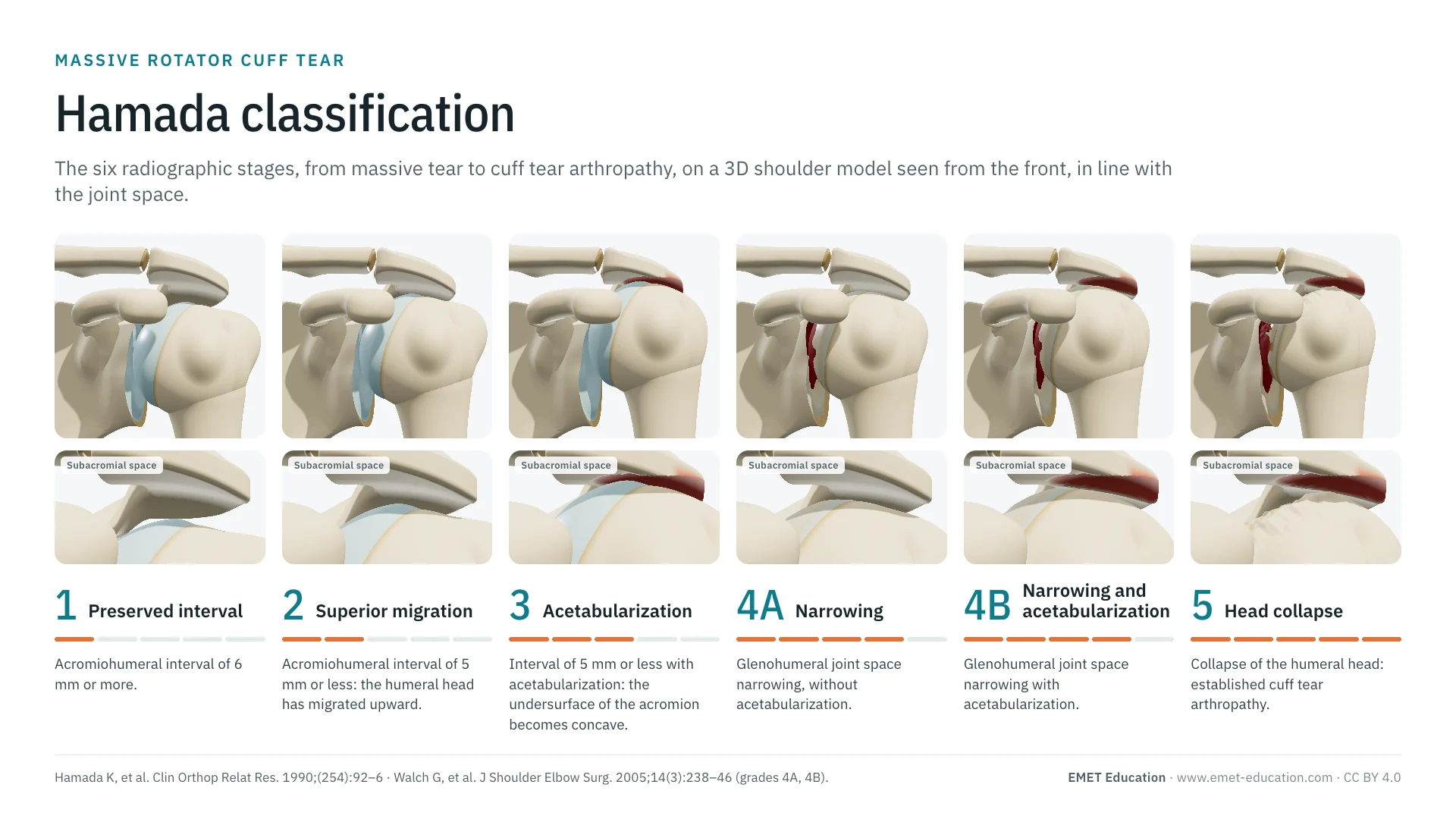 Infographic: the six Hamada grades on a 3D shoulder seen from the front, from grade 1 (preserved acromiohumeral interval) to grade 5 (humeral head migrated upward and collapsed under a hollowed acromion), with a zoom on the subacromial space under each grade.