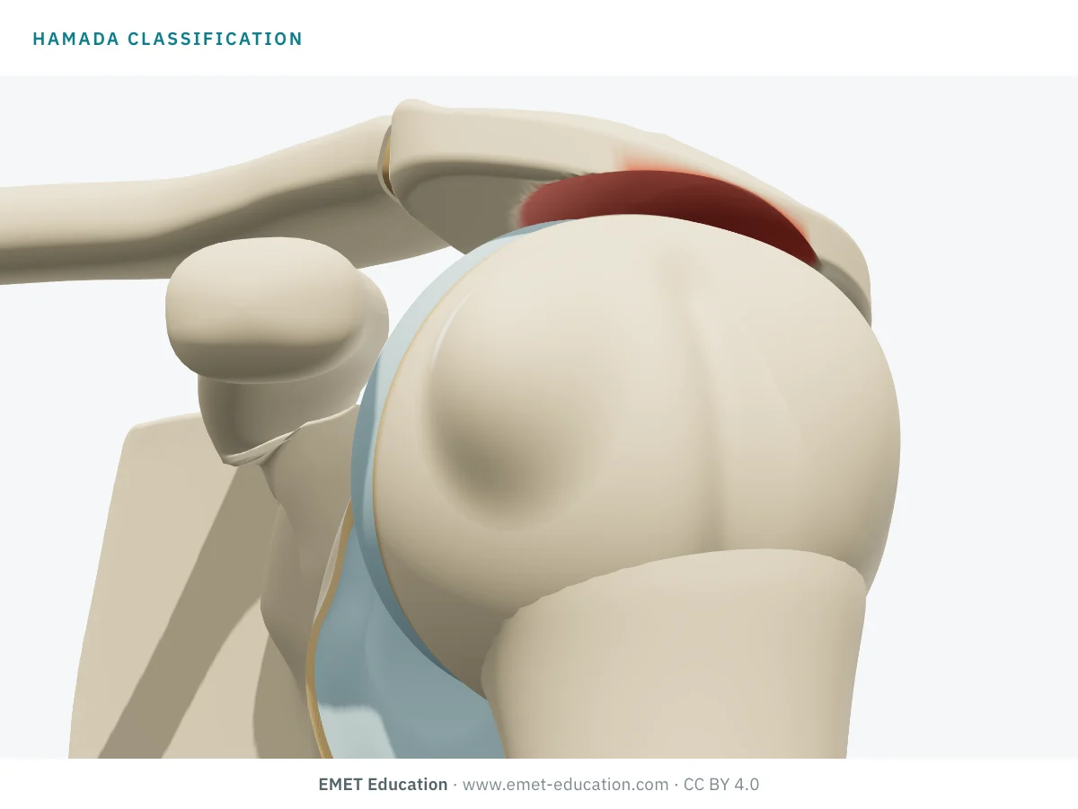 Shoulder in 3D seen from the front and side, at an unknown Hamada grade, for the self-test.