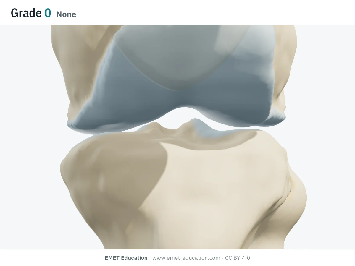 Knee in 3D, anterior view in extension with a transparent patella, grade 0: intact cartilage on both femoral condyles and tibial plateaus, no osteophyte.