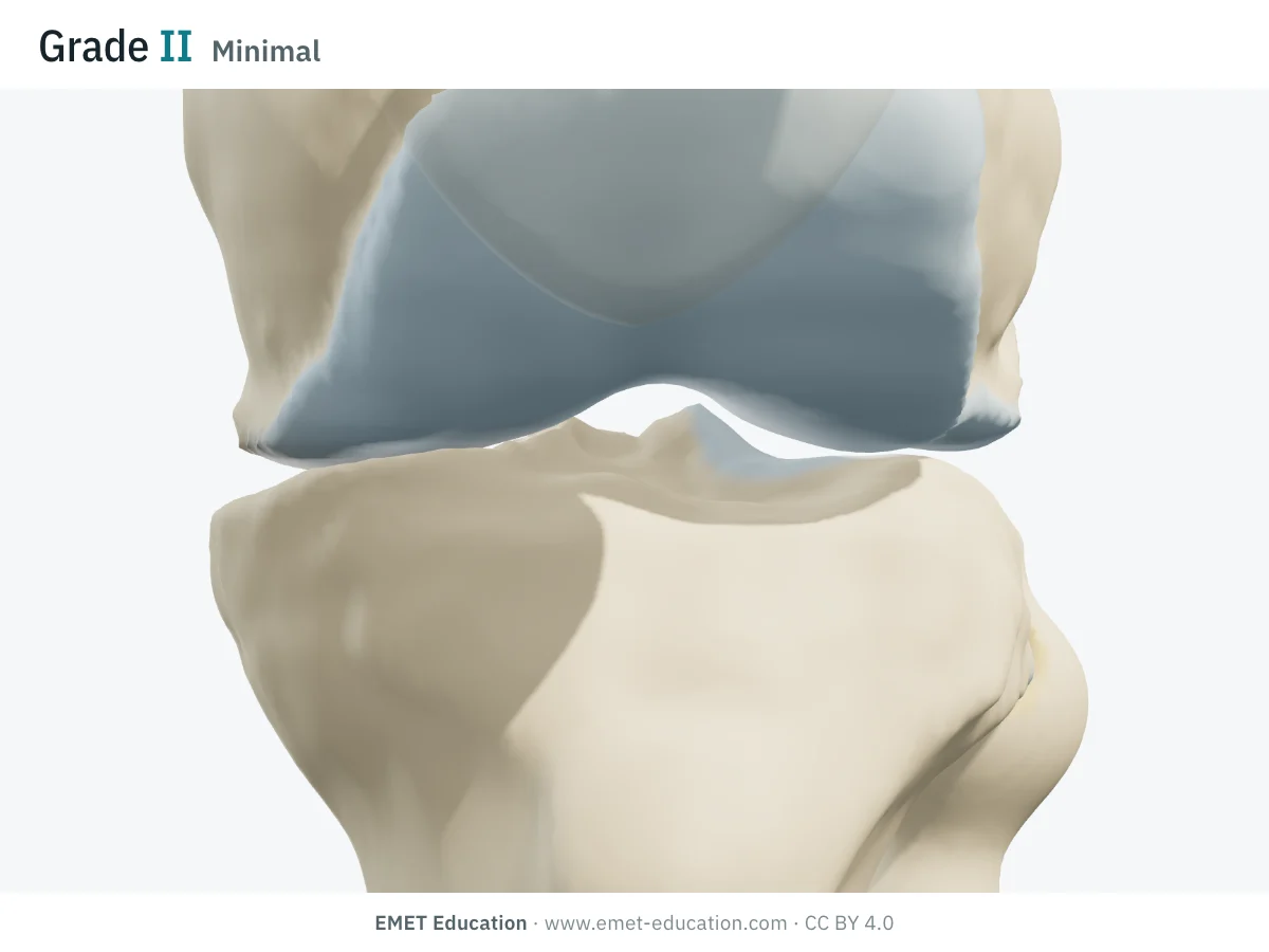 Knee in 3D, anterior view in extension, grade II: medial cartilage worn by half, definite osteophytes at the medial joint margins.