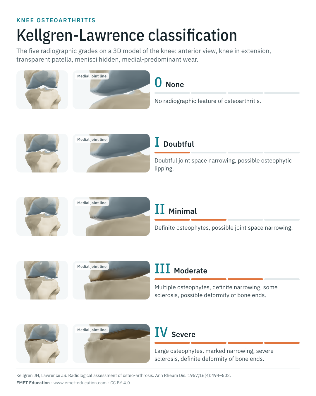 Portrait infographic of the five Kellgren-Lawrence grades, one row per grade.