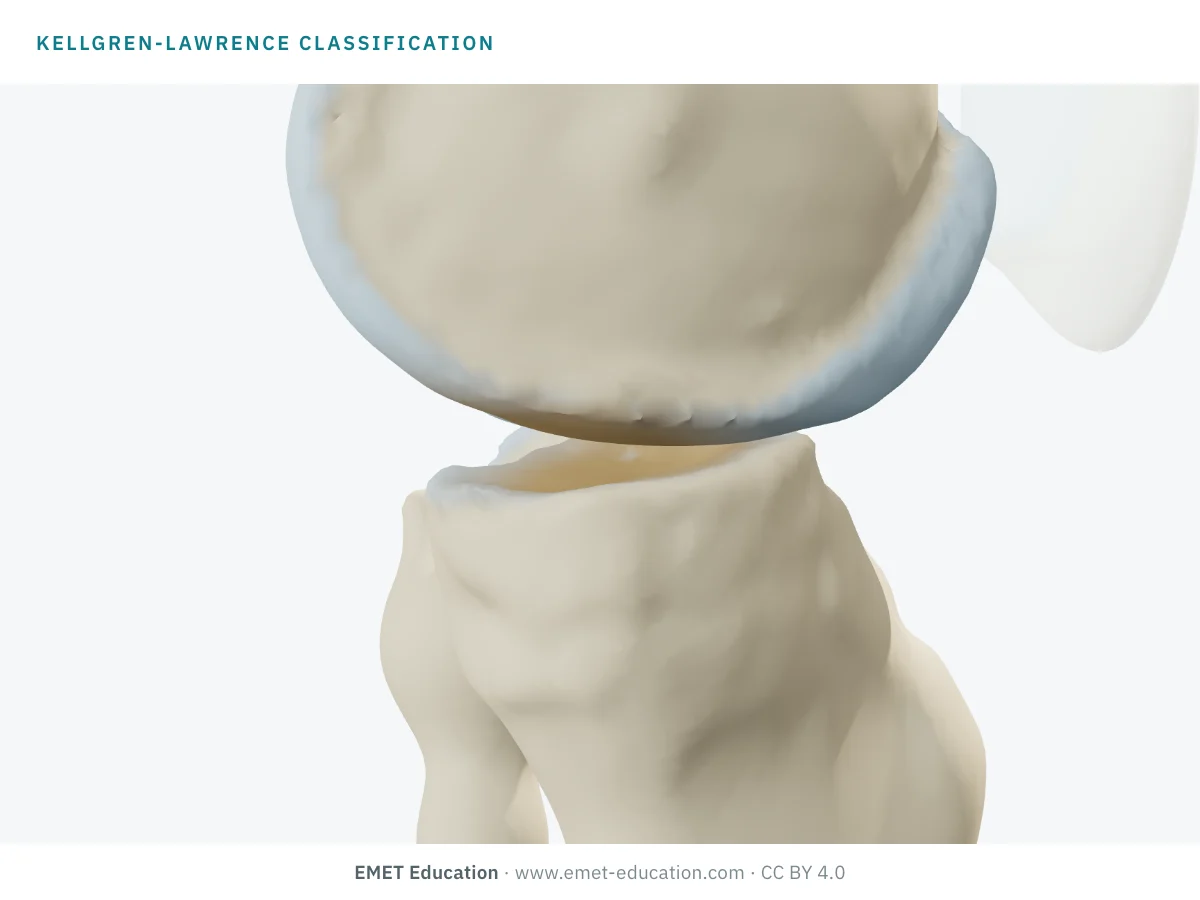 Knee in 3D seen from the medial side, at an unknown Kellgren-Lawrence grade, for the self-test.