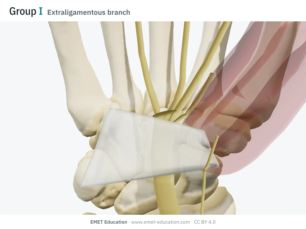 Wrist in 3D from the front, Lanz I extraligamentous: the thenar branch arises at the tunnel outlet, below the distal edge of the veiled ligament.