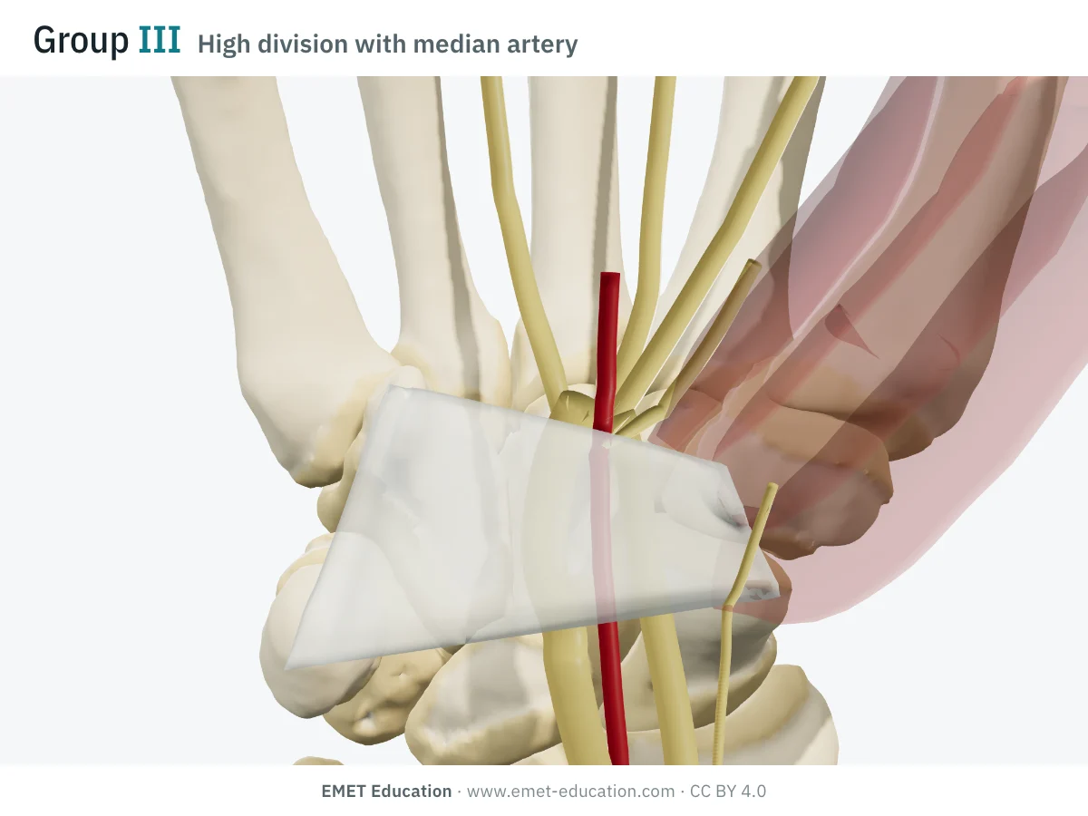 Wrist in 3D from the front, Lanz III with a persistent median artery: a red artery between the two trunks of the nerve.