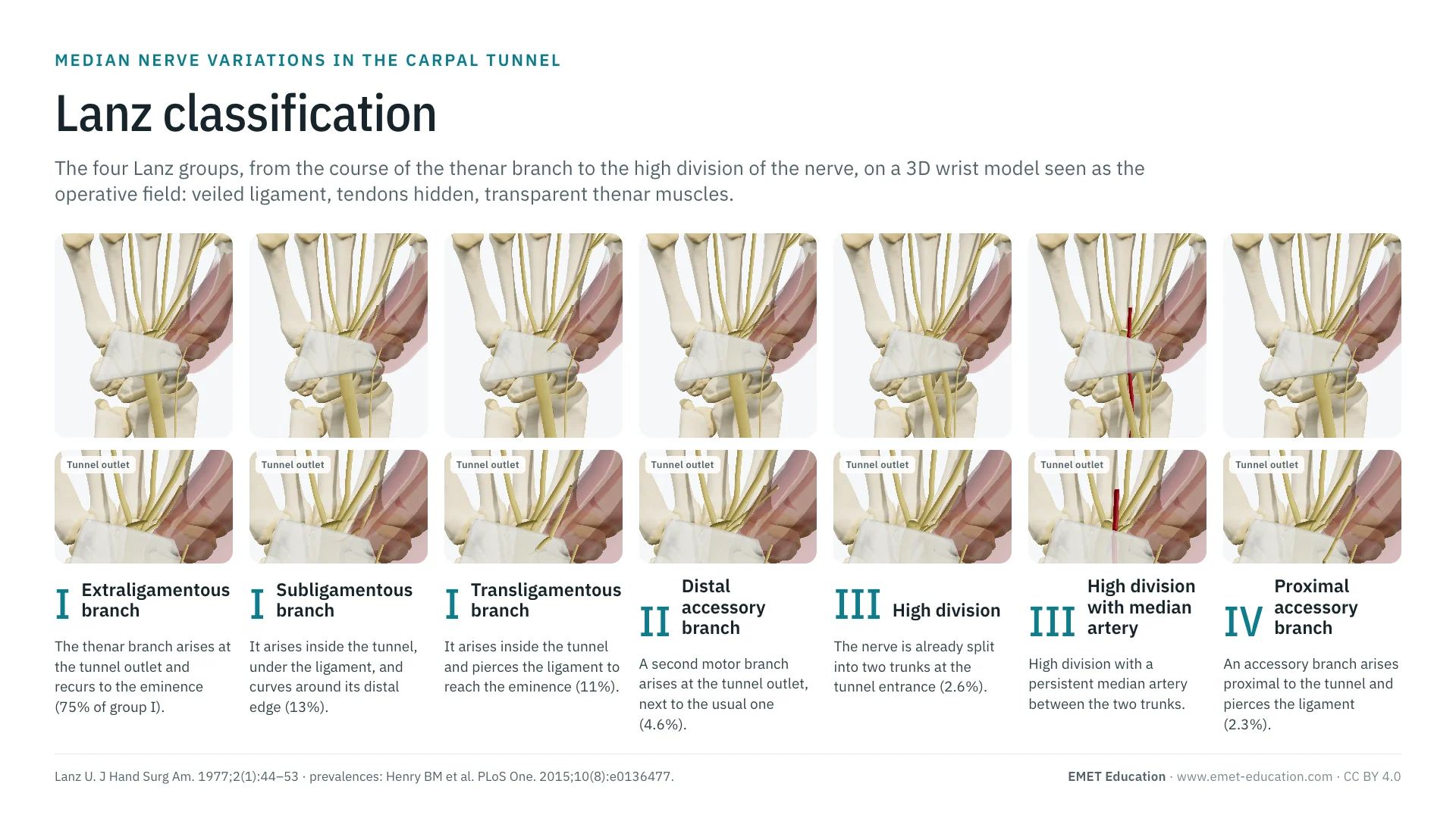 Infographic: the seven forms of the Lanz classification on a 3D wrist seen from the front, from the extraligamentous thenar branch to the proximal accessory branch piercing the ligament, with a zoom on the tunnel outlet under each form.
