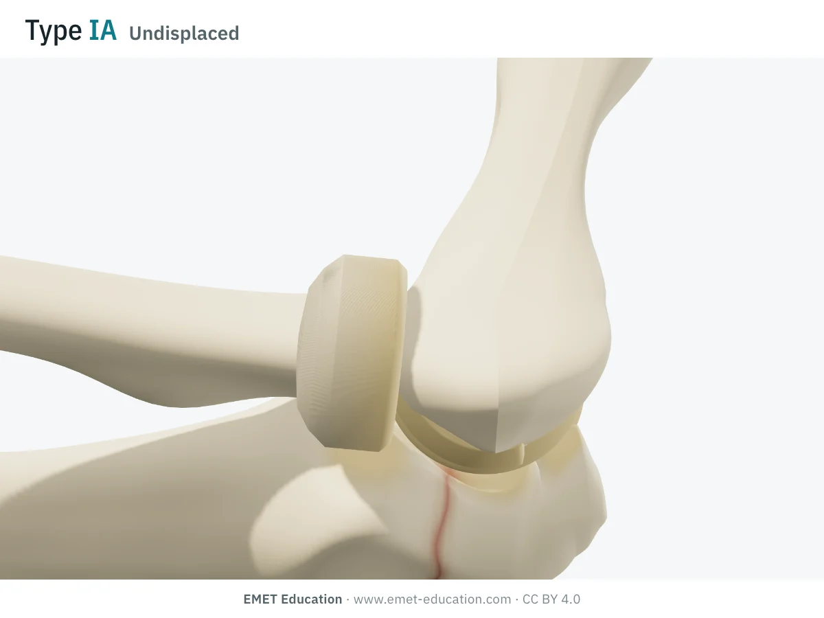 Elbow in 3D, lateral view, flexed 90°, Mayo type IA: thin fracture line across the olecranon, no gap.