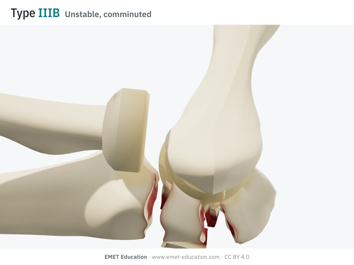 Elbow in 3D, lateral view, Mayo type IIIB: forearm dislocated anteriorly, comminuted olecranon.