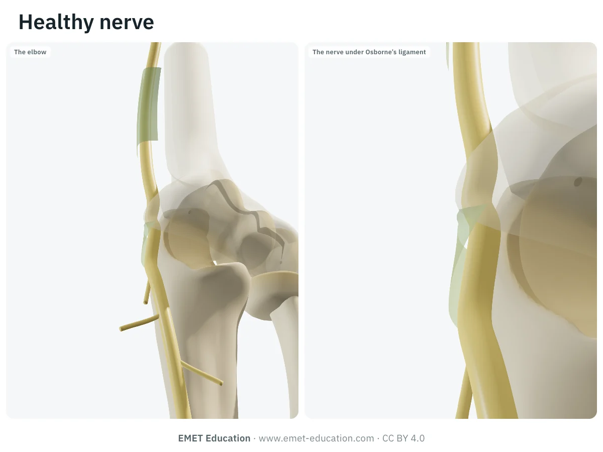 Healthy ulnar nerve at the elbow in 3D, posteromedial view, transparent humerus: slack Osborne's ligament, nerve of even caliber.