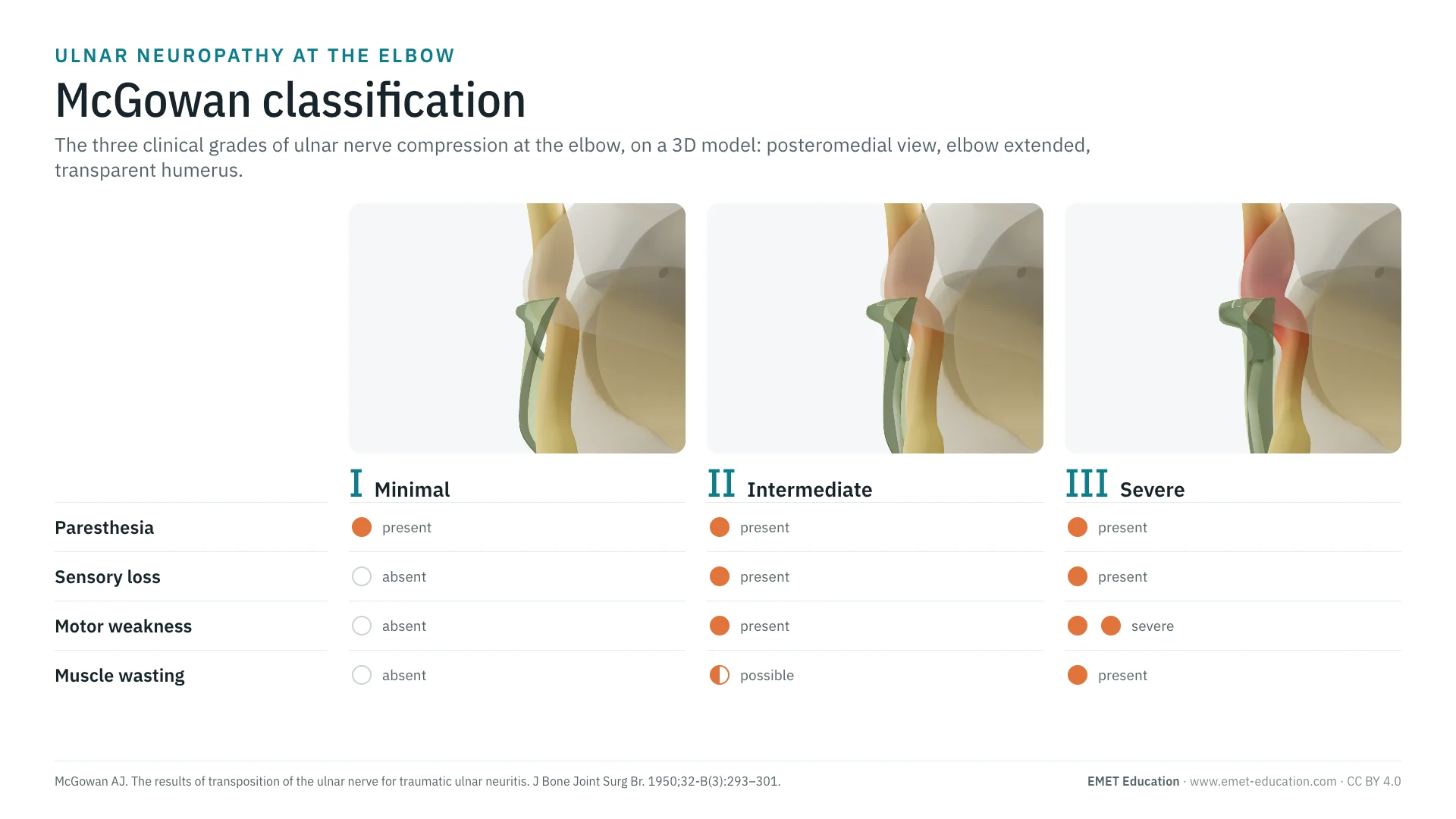 Infographic: McGowan grades I to III, the ulnar nerve under Osborne's ligament in 3D (more and more swollen and red above it), and a table of clinical signs by grade: paresthesia, sensory loss, motor weakness, muscle wasting.