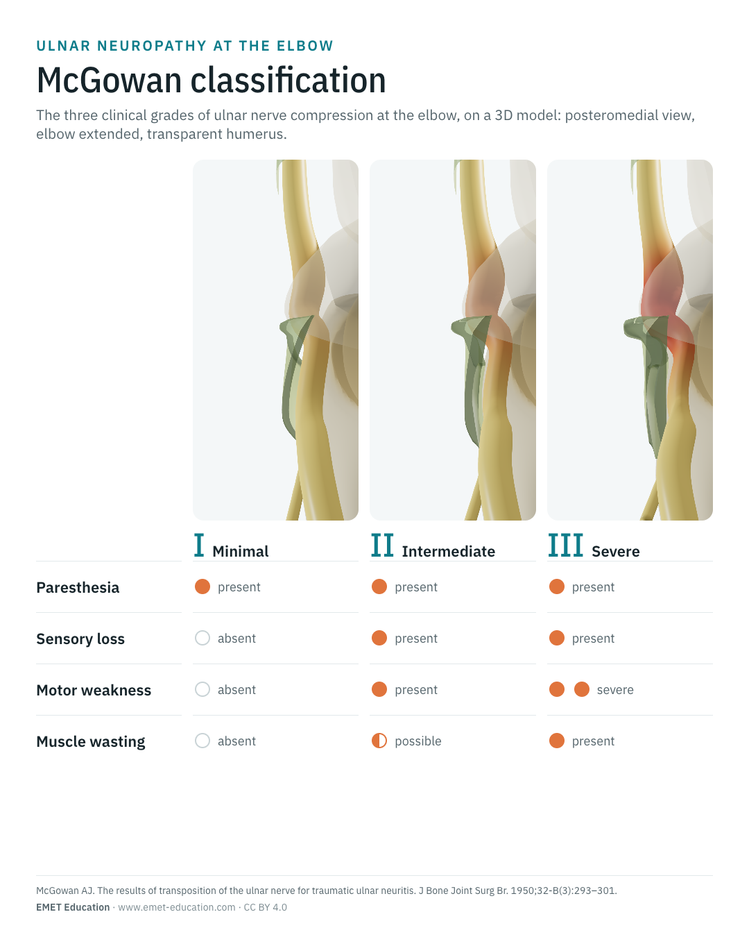 Portrait infographic of the McGowan classification: the nerve at the three grades, then the table of clinical signs.