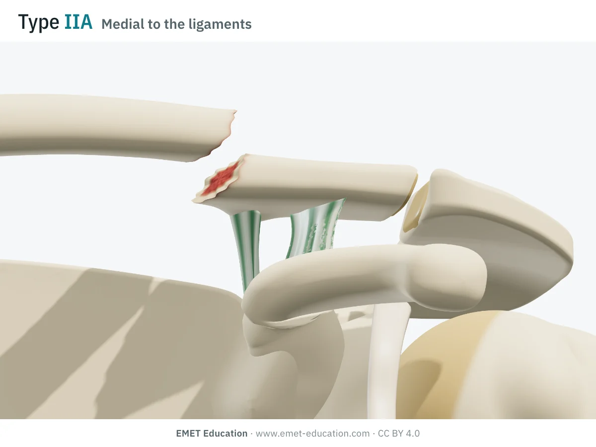 Shoulder in 3D, front view, Neer type IIA: fracture line medial to both ligaments, medial fragment raised.