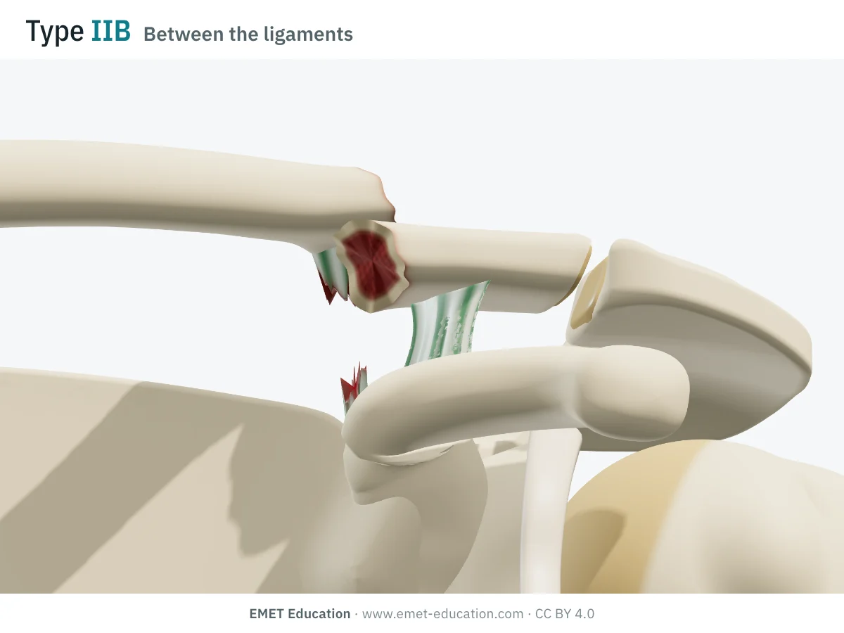 Shoulder in 3D, front view, Neer type IIB: fracture line between the two ligaments, conoid torn, medial fragment raised.