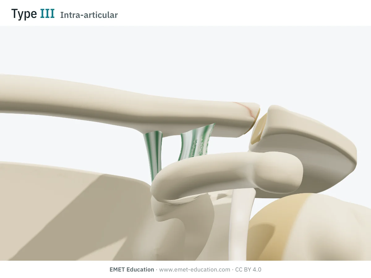Shoulder in 3D, front view, Neer type III: subtle fracture line of the lateral end of the clavicle into the acromioclavicular joint.