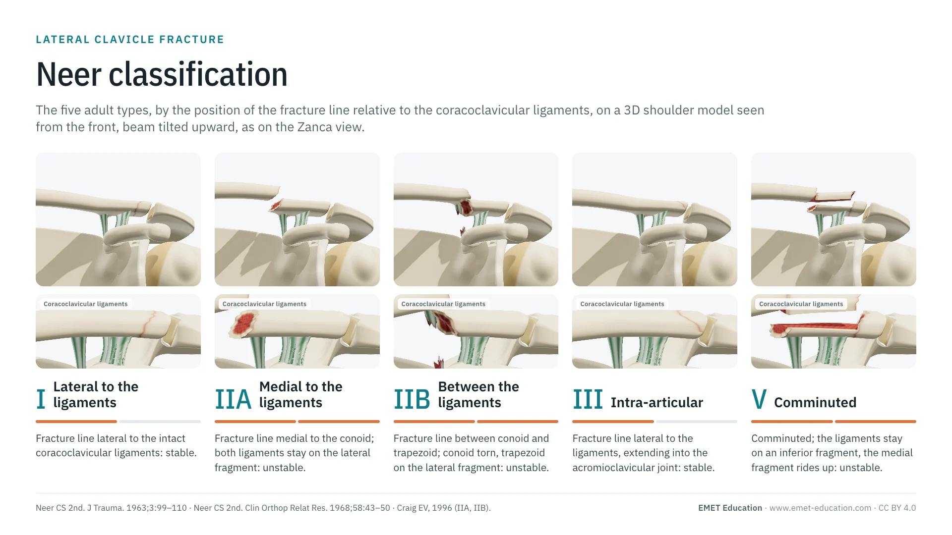 Infographic: the five adult Neer types on a 3D shoulder seen from the front, beam tilted upward, from the fracture lateral to the ligaments (I) to the comminuted fracture (V), with a zoom on the coracoclavicular ligaments under each type.