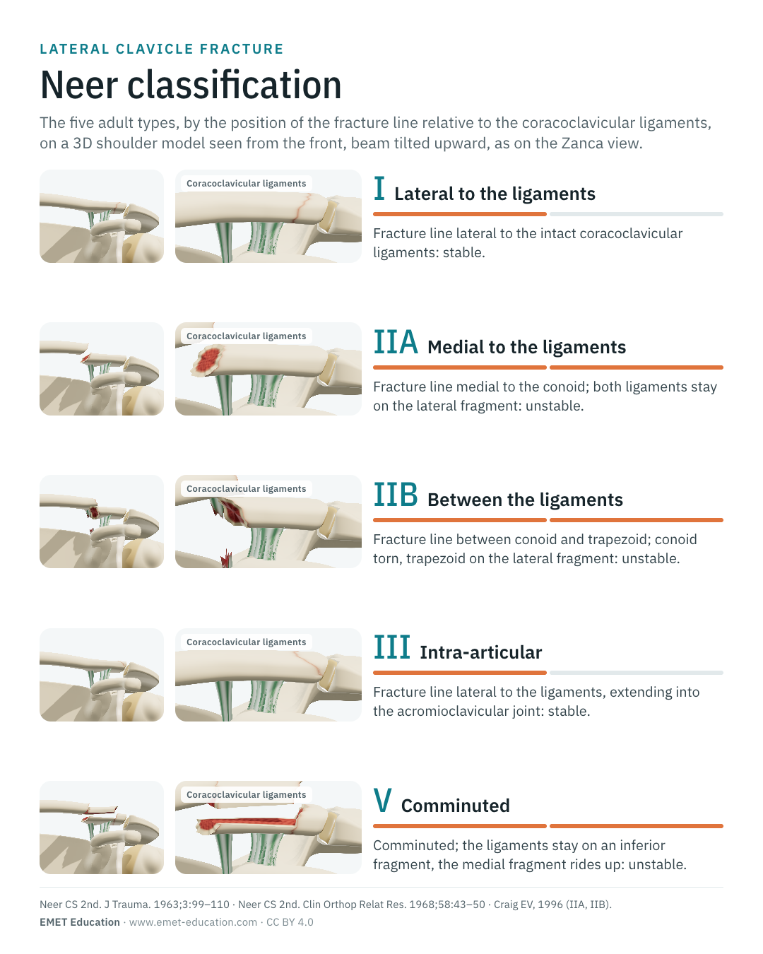 Portrait infographic of the five adult Neer types, one row per type.
