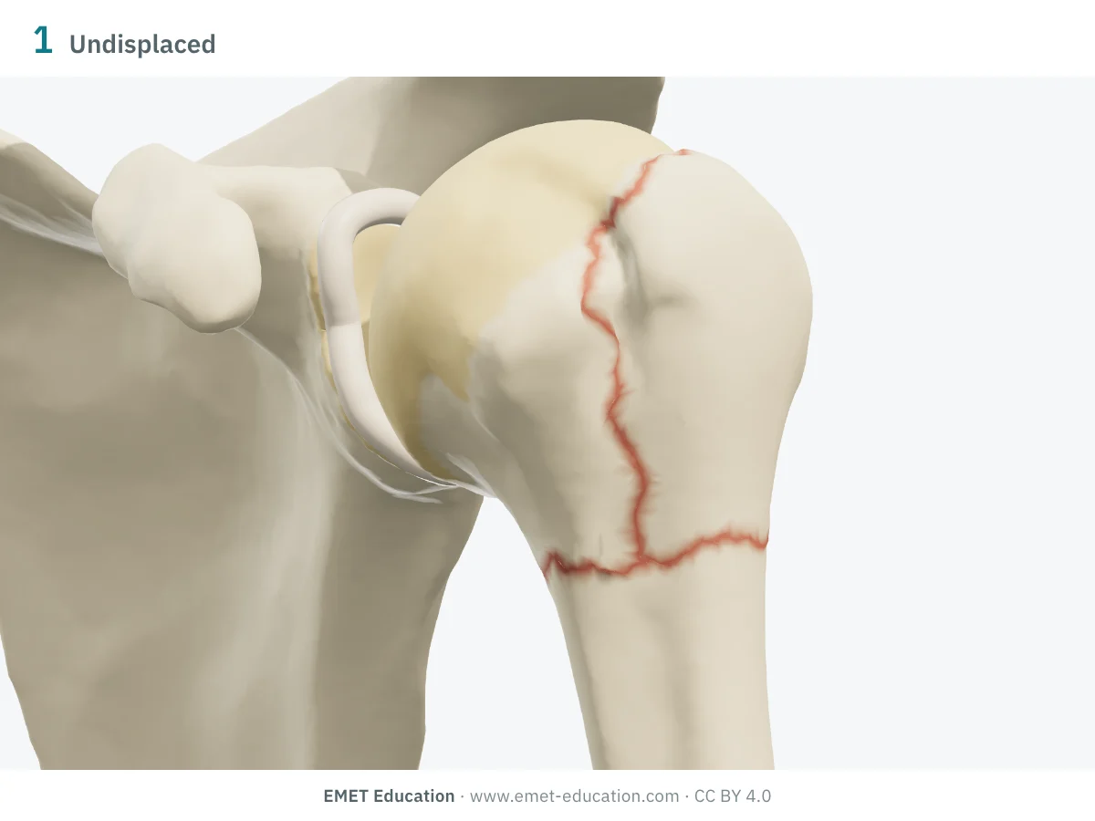 Left shoulder in 3D, front view, Neer one-part fracture: thin surgical neck and greater tuberosity lines, no displacement.