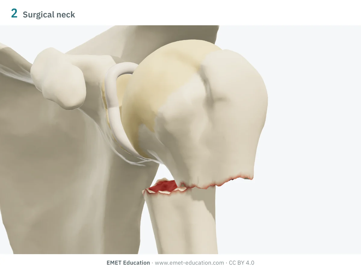Left shoulder in 3D, front view, two-part surgical neck fracture: the shaft shifted medially under the head.