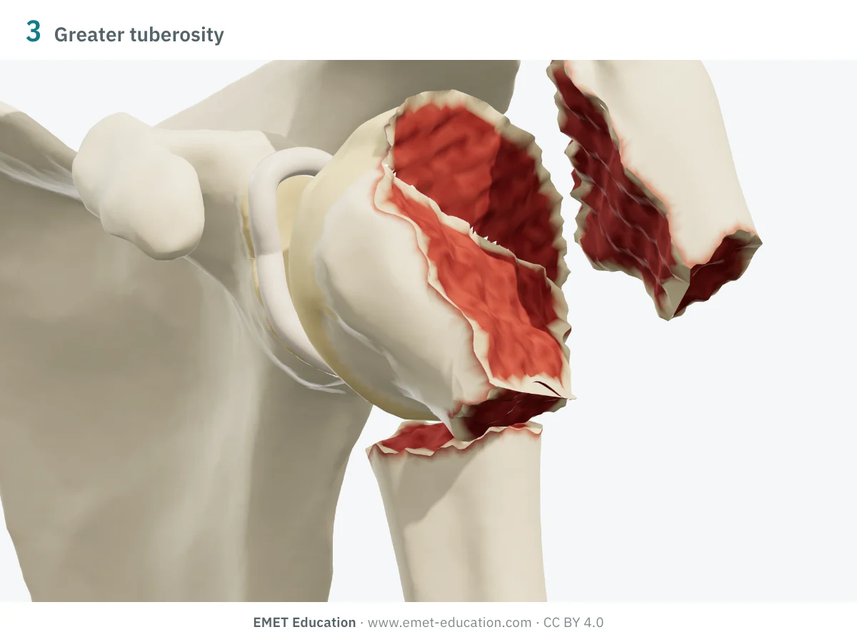 Left shoulder in 3D, front view, three-part fracture: surgical neck and greater tuberosity displaced, head in varus.