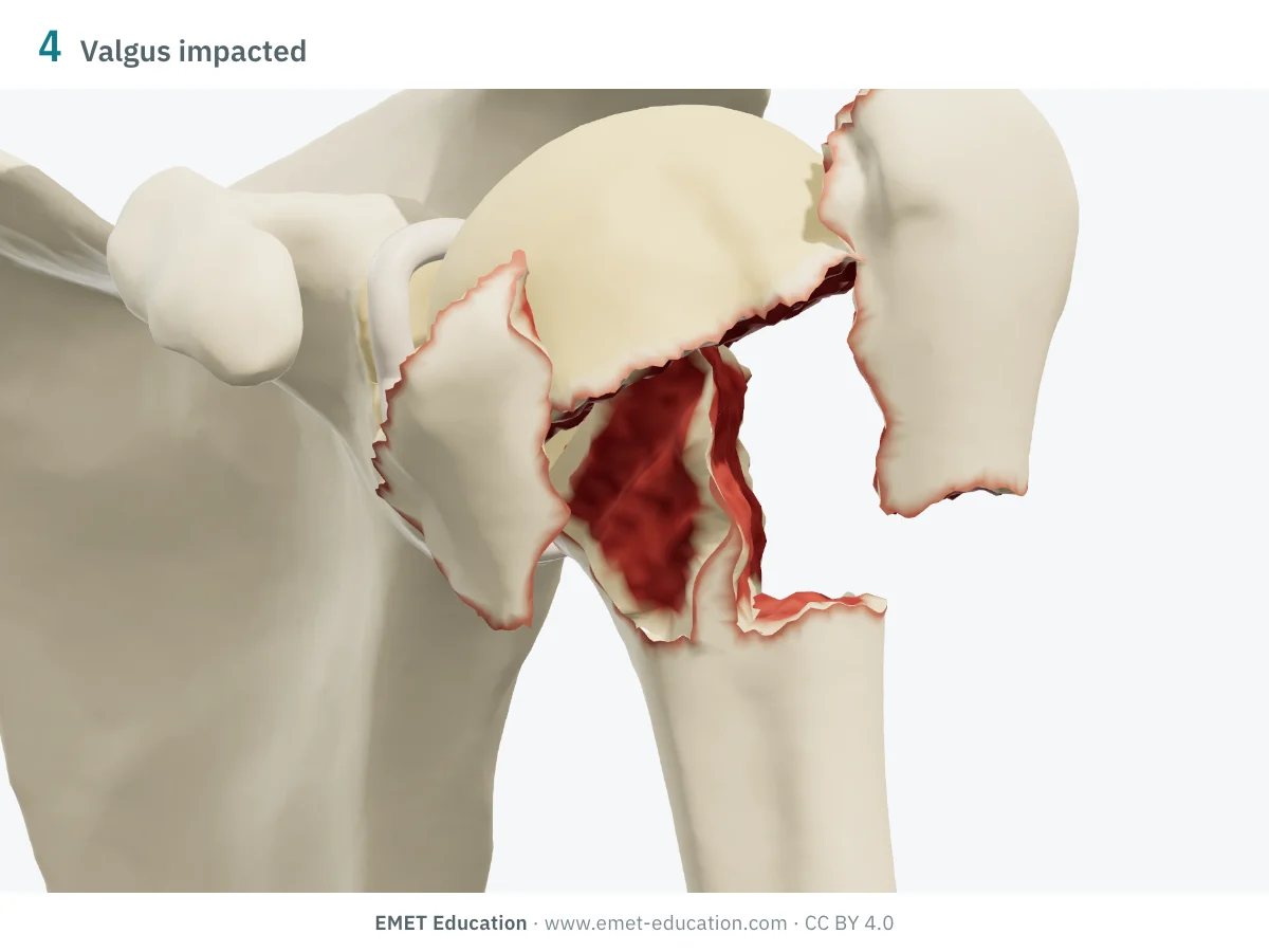 Left shoulder in 3D, front view, four-part valgus impacted fracture: head driven down between the splayed tuberosities.
