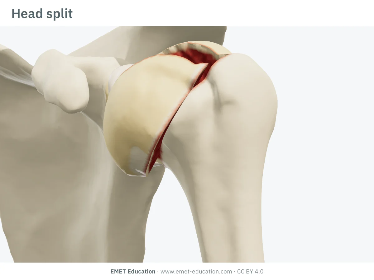 Left shoulder in 3D, front view, head split: an anterior fragment of the articular surface opened forward.