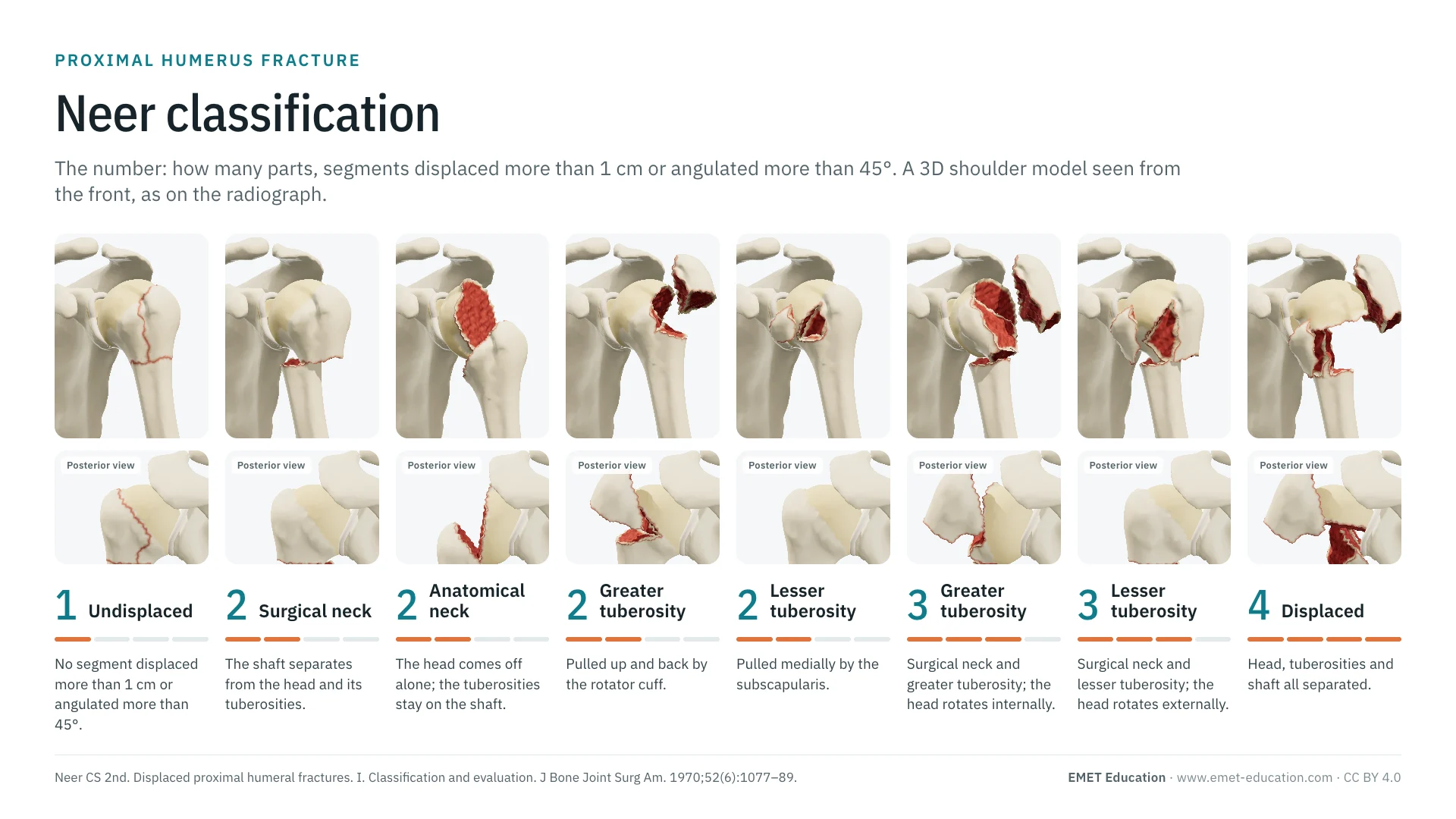 Infographic: the Neer one- to four-part categories on a 3D shoulder seen from the front, from the undisplaced fracture to the four-part fracture, with a posterior view under each category.