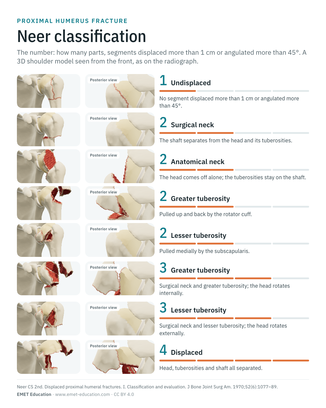 Portrait infographic of the Neer one- to four-part categories, one row per category.