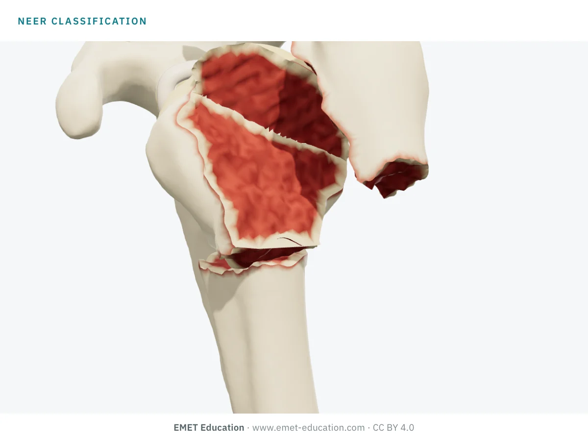 Shoulder in 3D seen from the front at three-quarters, at an unknown Neer category, for the self-test.