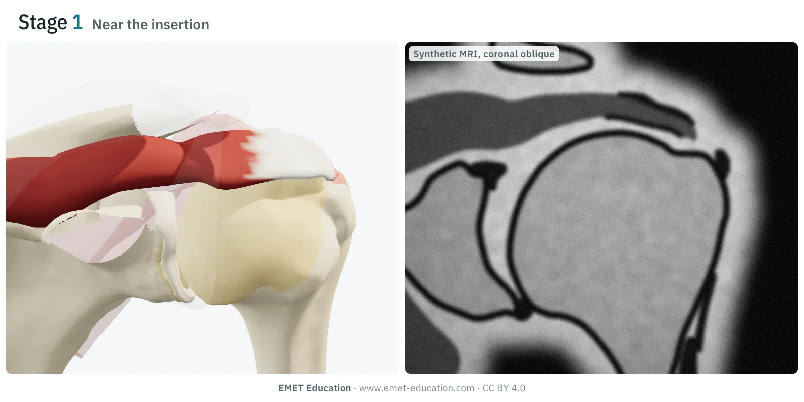 Shoulder in 3D and synthetic MRI slice, Patte stage 1: the detached supraspinatus stays at the edge of its footprint on the greater tuberosity.