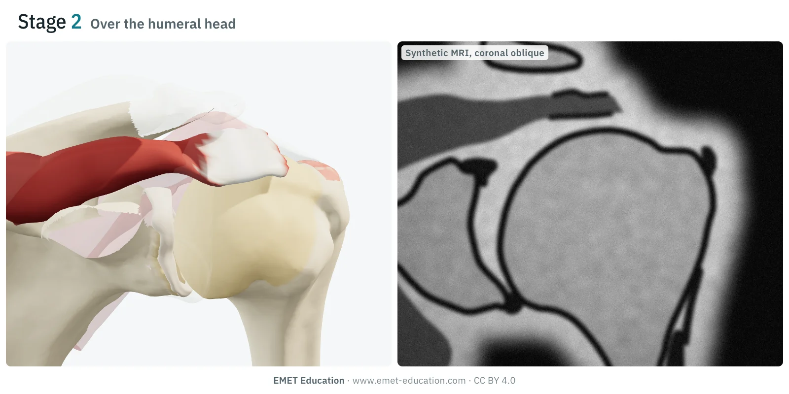 Shoulder in 3D and synthetic MRI slice, Patte stage 2: the supraspinatus stump lies over the humeral head, the footprint is uncovered.