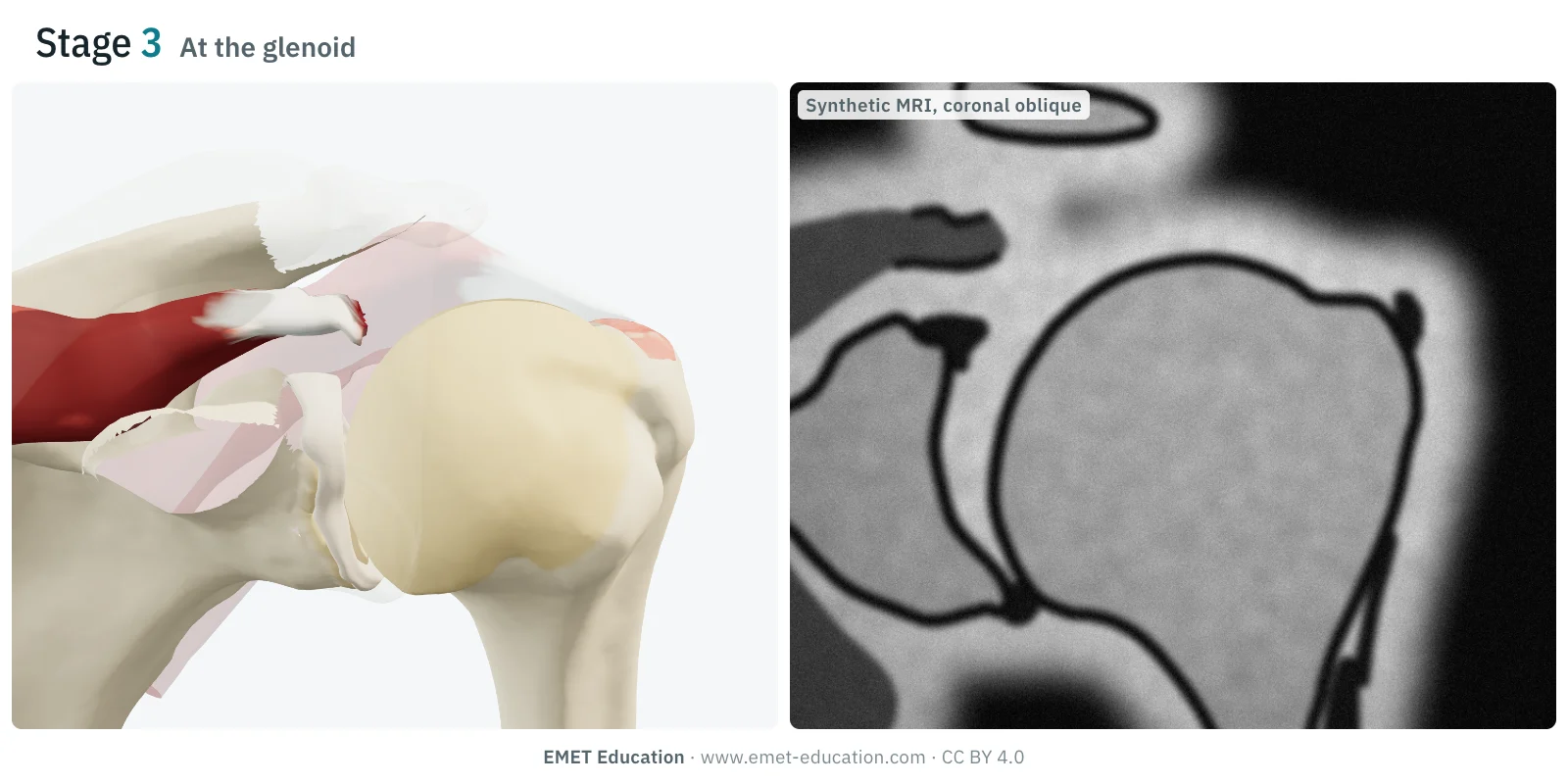 Shoulder in 3D and synthetic MRI slice, Patte stage 3: the supraspinatus stump has retracted above the glenoid, the humeral head is uncovered.
