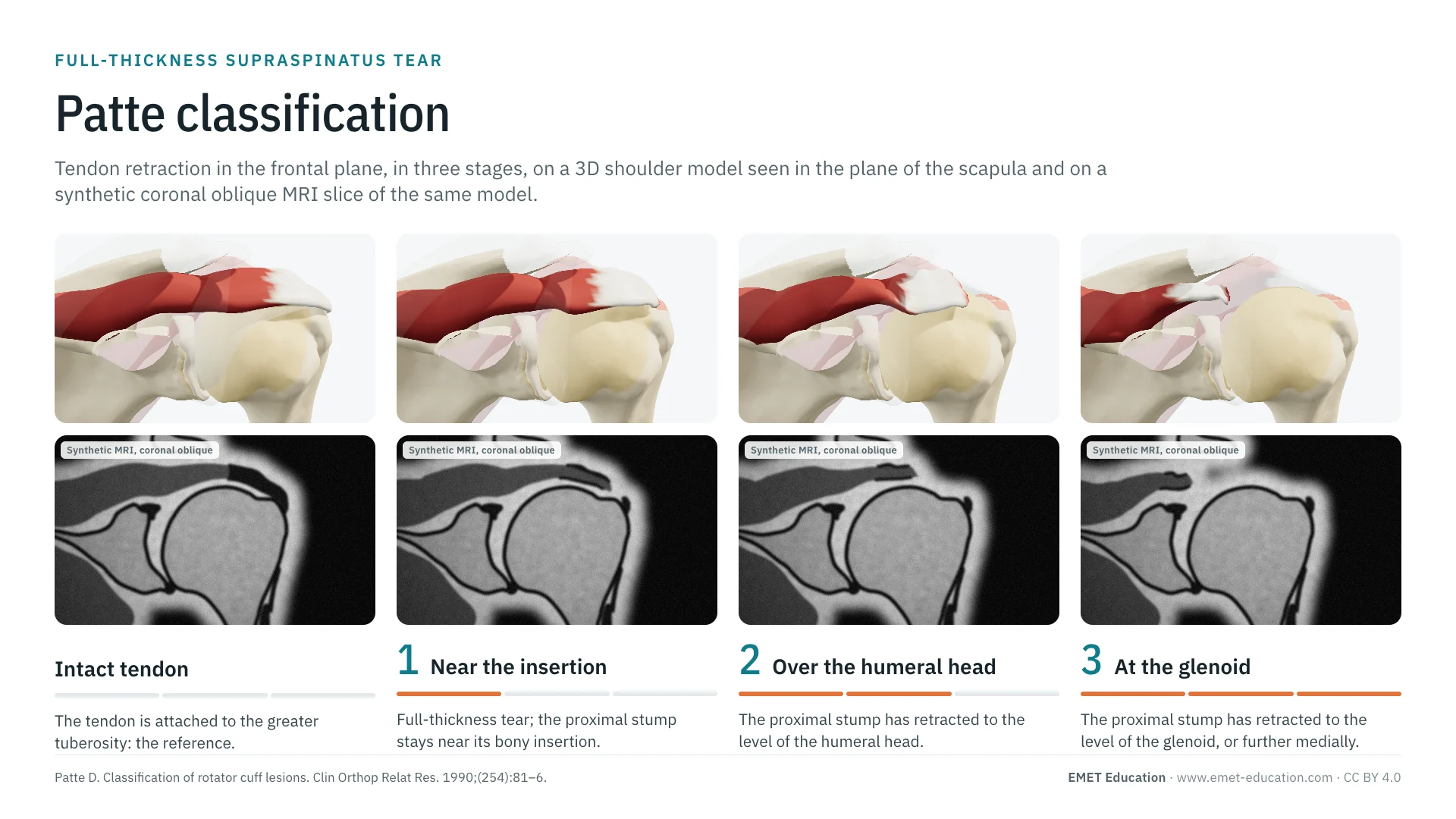 Infographic: the Patte classification on a 3D shoulder seen in the plane of the scapula, from the intact tendon to stage 3, with the matching synthetic coronal oblique MRI slice under each image.