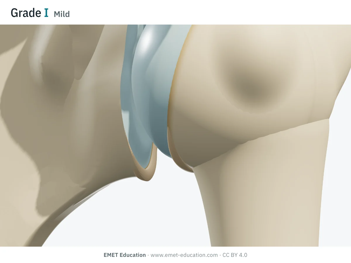 Shoulder in 3D, front view, Samilson-Prieto grade I: thin osteophytes under the humeral head and under the glenoid.