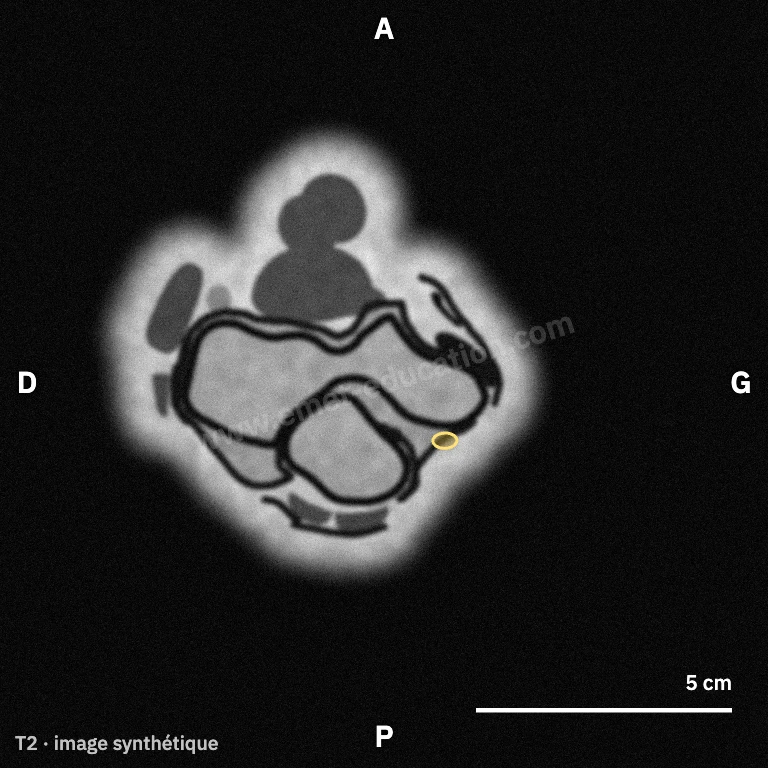 IRM synthétique, coupe axiale au niveau de l'épicondyle médial : le nerf ulnaire dans la gouttière.