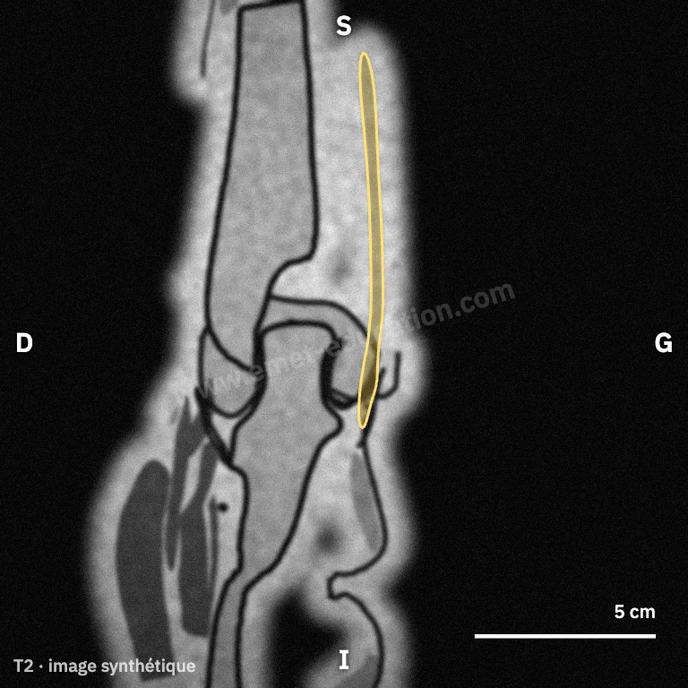 IRM synthétique, coupe coronale postérieure : le nerf ulnaire sur toute sa hauteur derrière l'épicondyle médial.