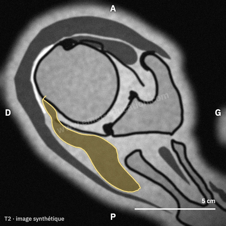 IRM synthétique, coupe axiale au-dessus du centre de la tête : corps charnu et tendon de l'infra-épineux en arrière de la tête.