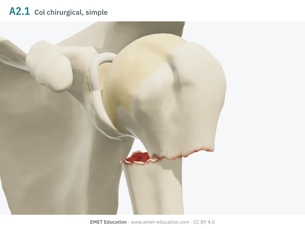 Épaule gauche en 3D vue de face, code 11A2.1 : la diaphyse décalée en dedans sous la tête.