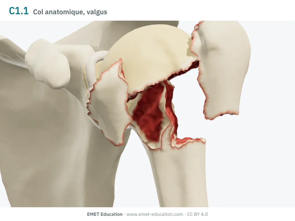 Épaule gauche en 3D vue de face, code 11C1.1 : tête impactée en valgus entre les tubercules écartés.