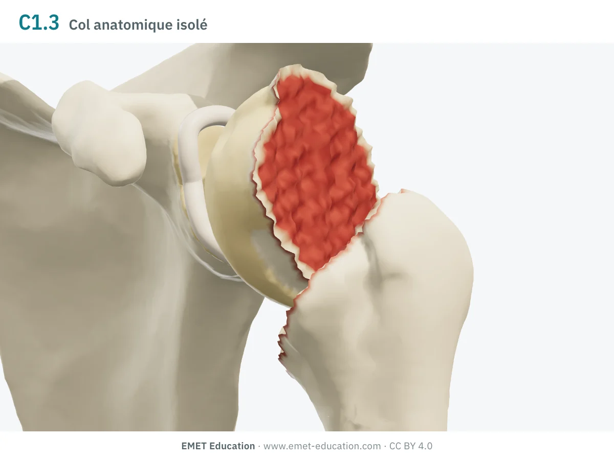 Épaule gauche en 3D vue de face, code 11C1.3 : la tête détachée au col anatomique, basculée en varus.