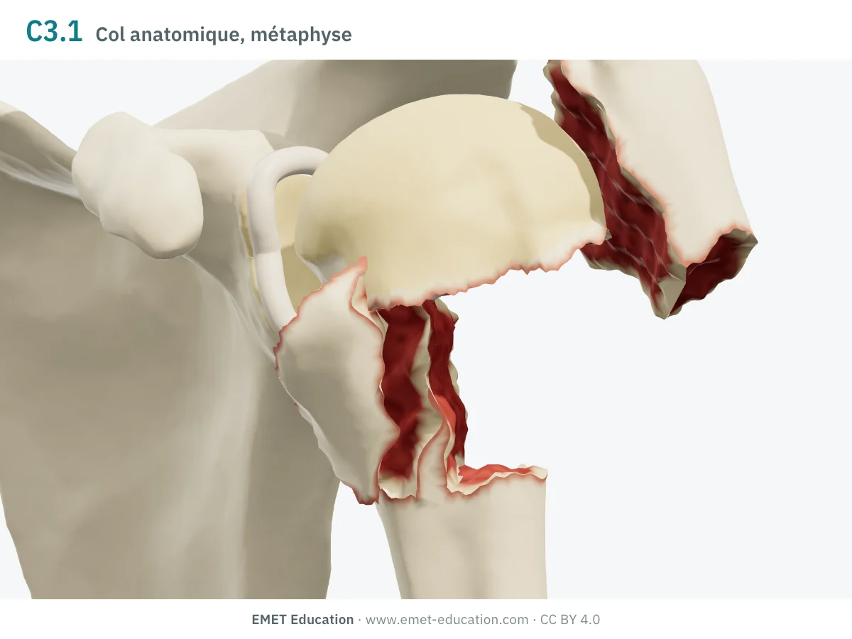 Épaule gauche en 3D vue de face, code 11C3.1 : tête en valgus, tubercules séparés, diaphyse translatée.
