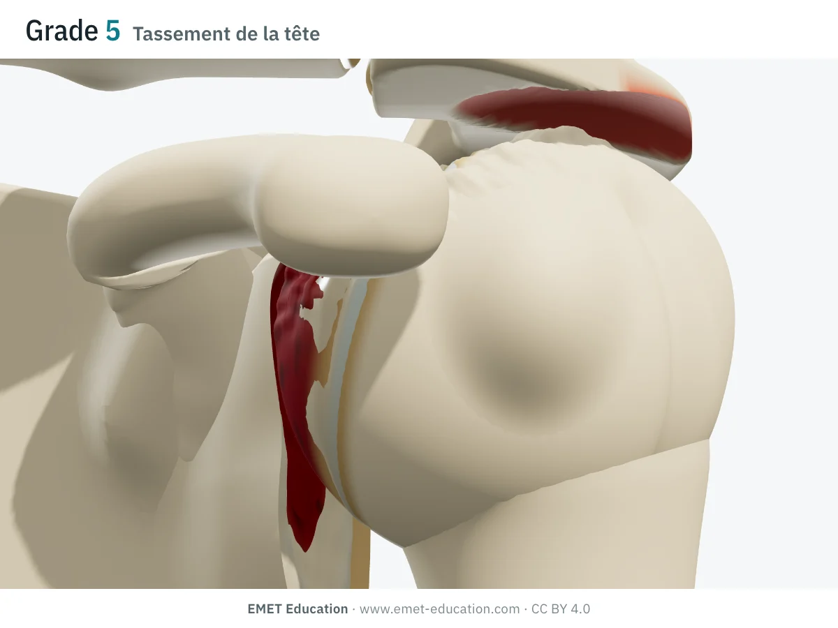 Épaule en 3D vue de face, grade 5 de Hamada : sommet de la tête humérale aplati et irrégulier, au contact d'un acromion creusé.