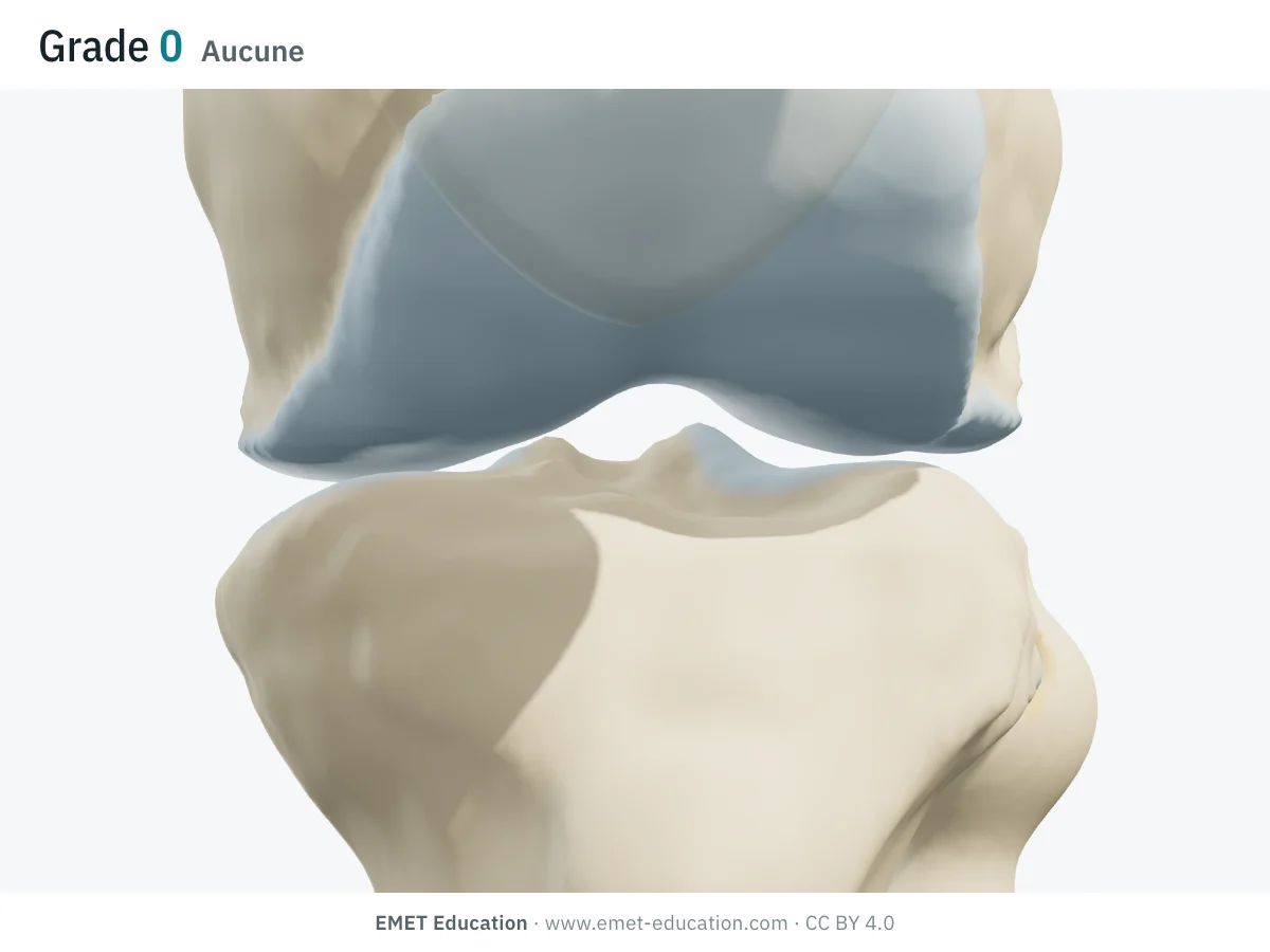 Genou en 3D vu de face en extension, rotule transparente, grade 0 : cartilage intact sur les deux condyles et les deux plateaux tibiaux, aucun ostéophyte.