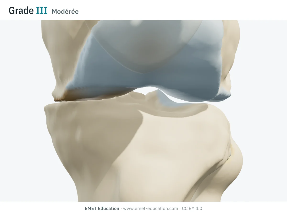 Genou en 3D vu de face en extension, grade III : cartilage interne presque disparu, os sous-chondral à nu, ostéophytes plus gros et interligne interne pincé.
