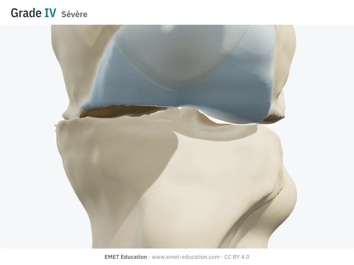Genou en 3D vu de face en extension, grade IV : os à nu et tassé dans le compartiment interne, interligne fermé, gros ostéophytes et usure externe moindre.