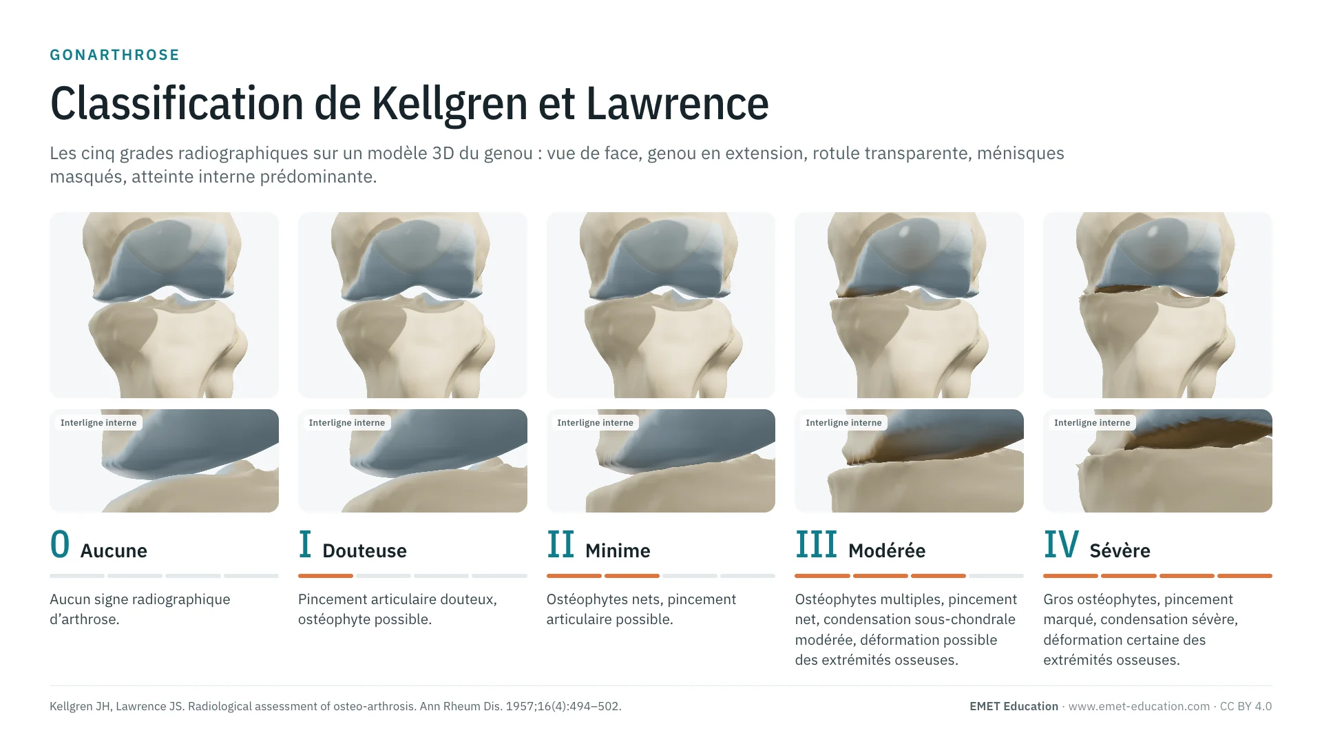 Infographie : les cinq grades de Kellgren et Lawrence sur un genou en 3D vu de face en extension, du grade 0 (cartilage normal) au grade IV (interligne interne fermé, os à nu et tassé), avec un zoom de l'interligne interne sous chaque grade.