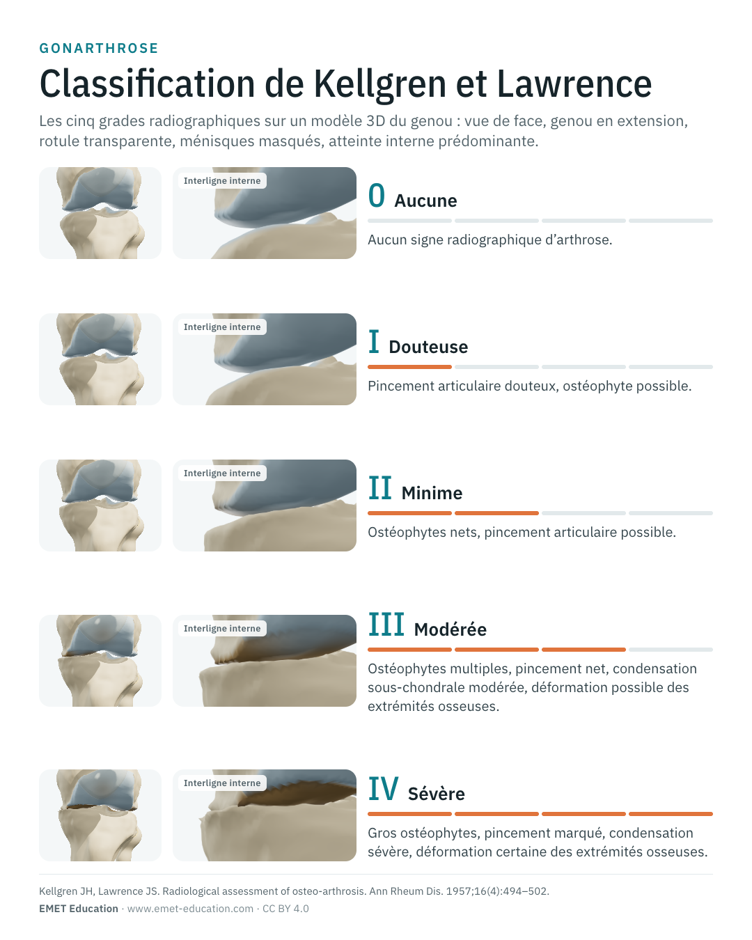 Infographie en portrait des cinq grades de Kellgren et Lawrence, une ligne par grade.