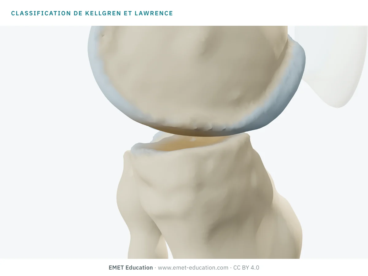 Genou en 3D vu par sa face interne, à un grade de Kellgren et Lawrence inconnu, pour l'autoévaluation.