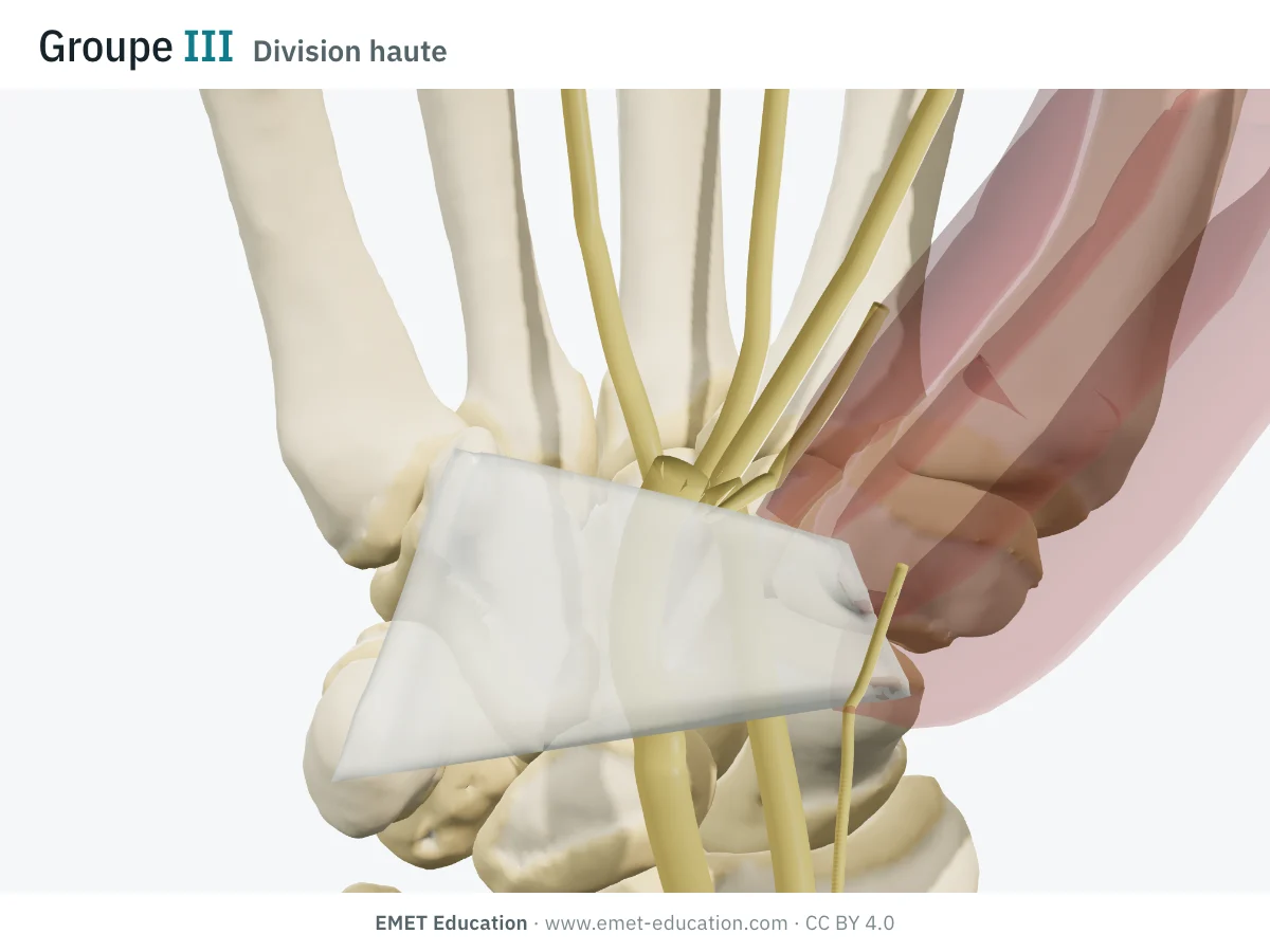 Poignet en 3D vu de face, Lanz III : deux troncs du nerf médian côte à côte sous le ligament.