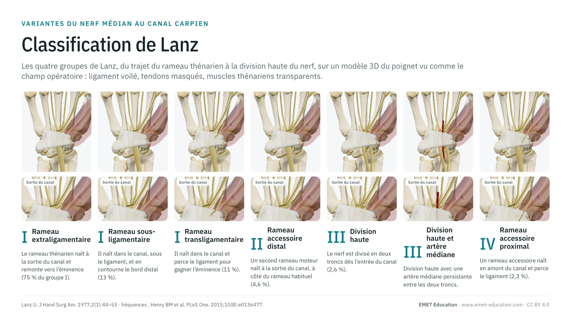 Infographie : les sept formes de la classification de Lanz sur un poignet en 3D vu de face, du rameau thénarien extraligamentaire au rameau accessoire proximal qui perce le ligament, avec un zoom de la sortie du canal sous chaque forme.